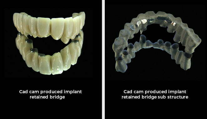 , Dental Implants