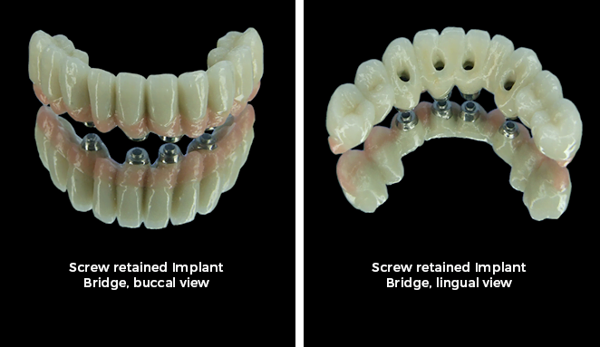 , Dental Implants