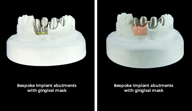 , Dental Implants