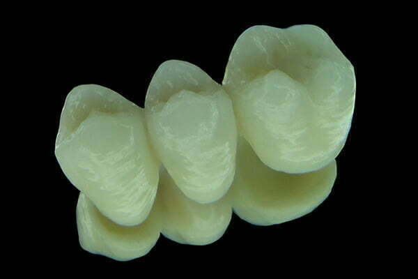 , Crowns and Bridges