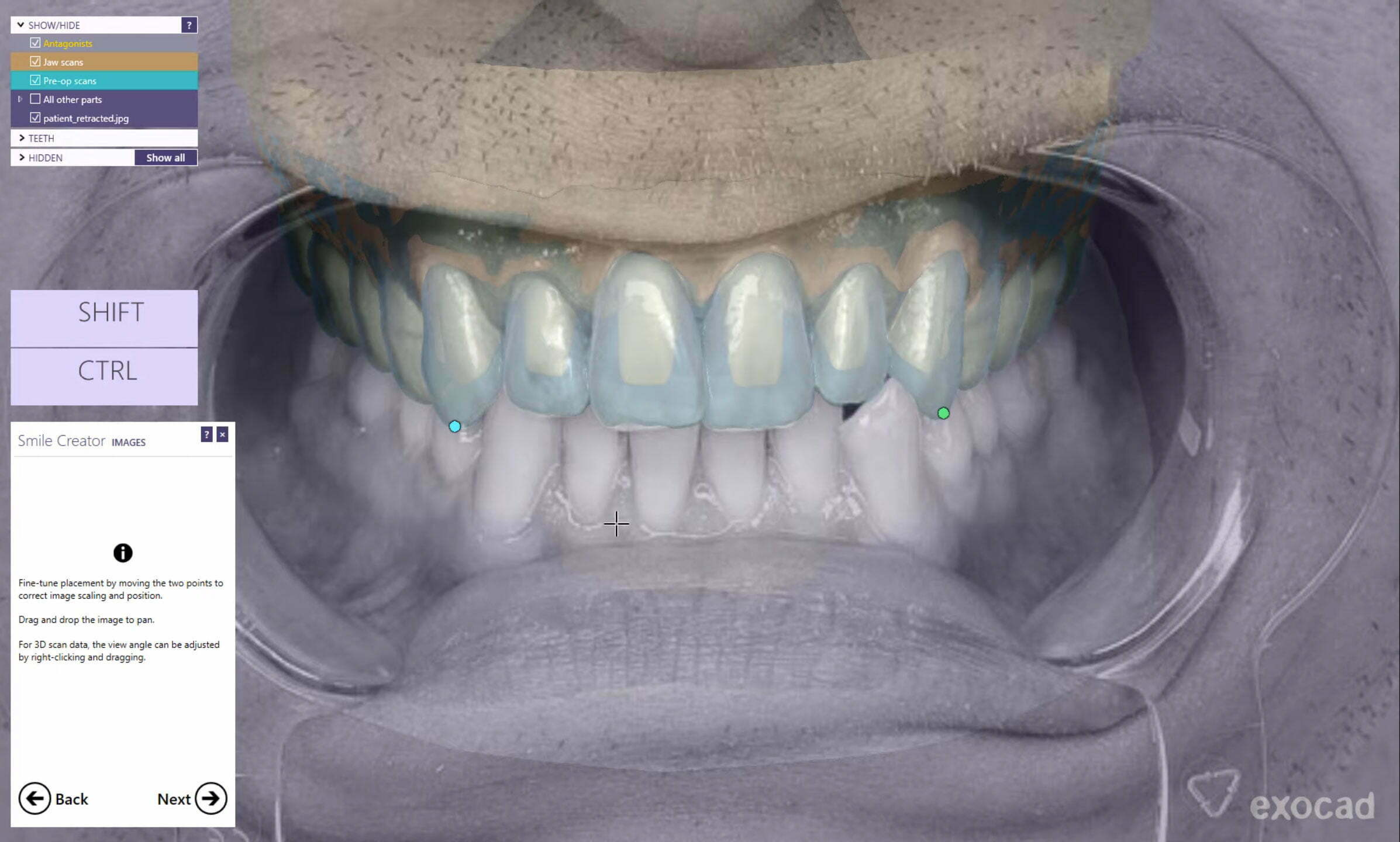 , Digital Smile Design