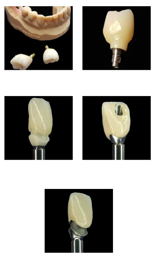 , Crowns and Bridges